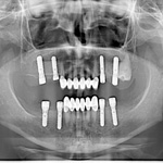 Closure Screws & Healing Caps