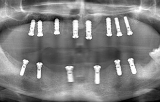 BIOCONCEPT S-L-A Implant Clinical Case